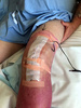 Knee surgery 7nov16.jpg